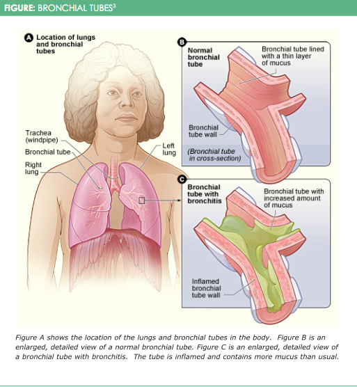 Chronic Bronchitis